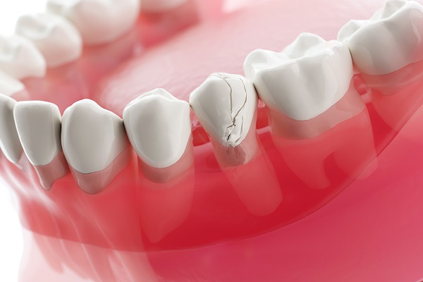 Temporary Broken Teeth Repair, Temporary Convenient Tooth Filling