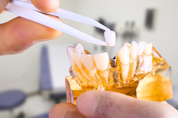 CEREC Single Visit Dentistry — No Need For A Temporary Crown