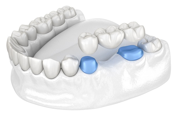 How Long Do Dental Bridges Last All Smiles Dental Center San Antonio 